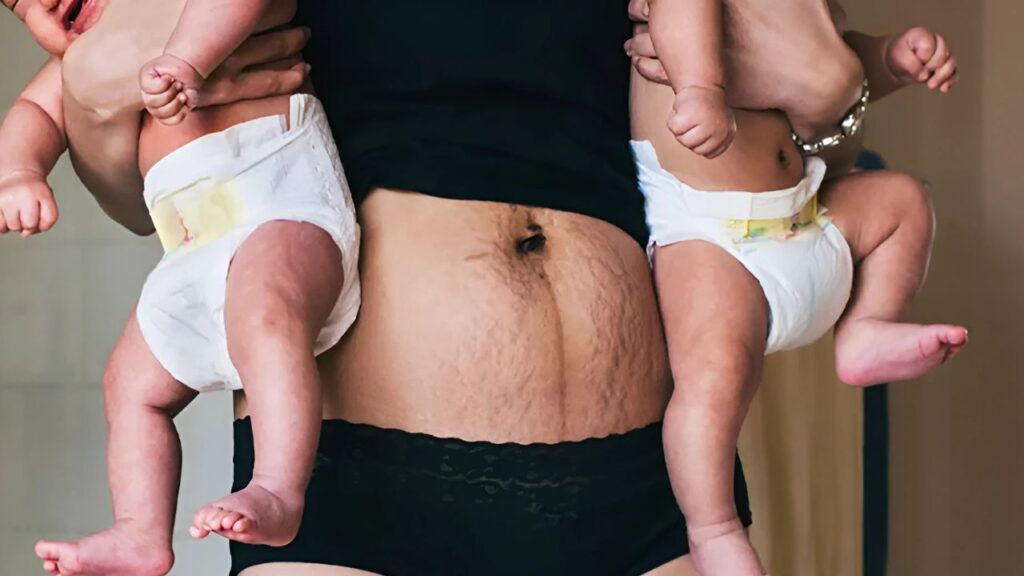 Recovery after childbirth